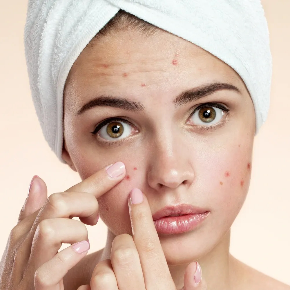 Acne-Treatment